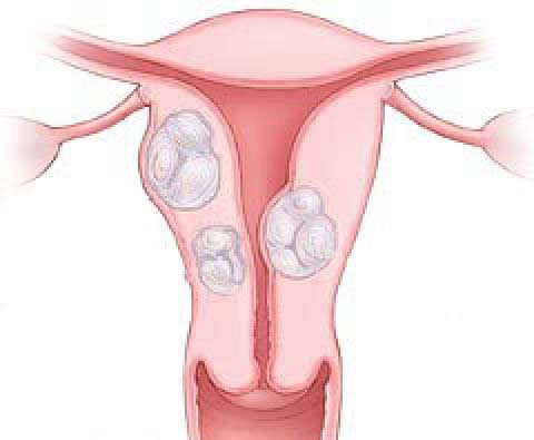 Потенциал для новых методов лечения миомы матки