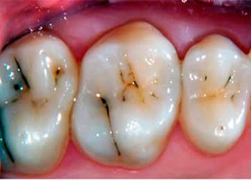 Заболевания зубов: кариес